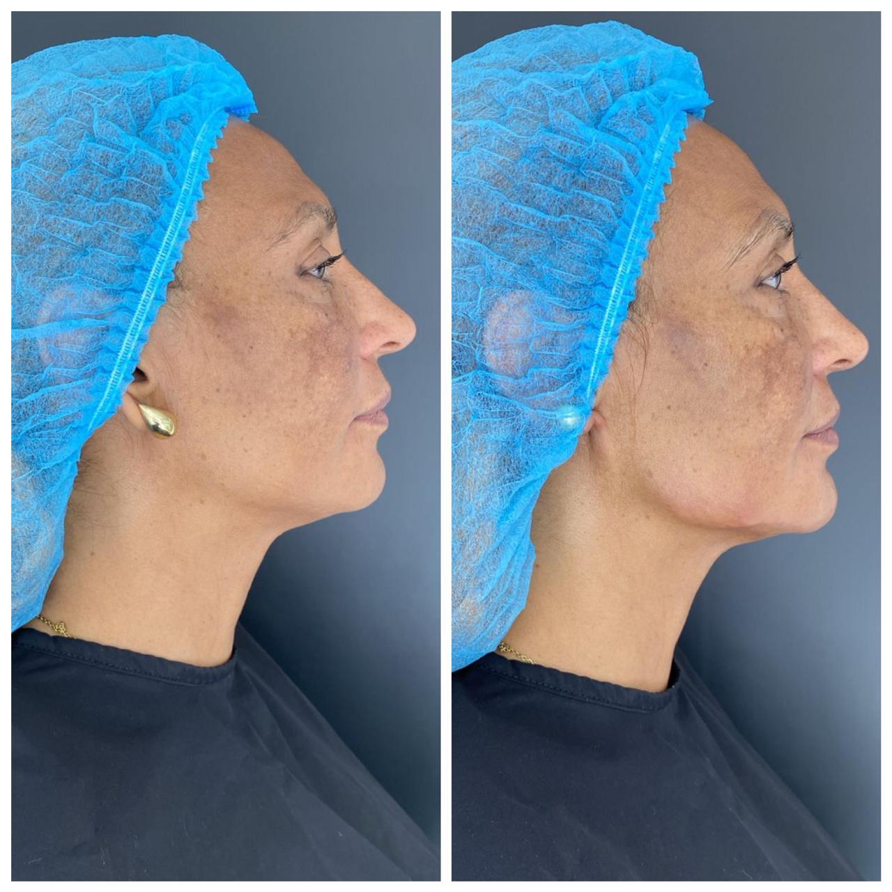 Antes y después real · Contorno mandibular y cuello · Radiant Skin Bogotá