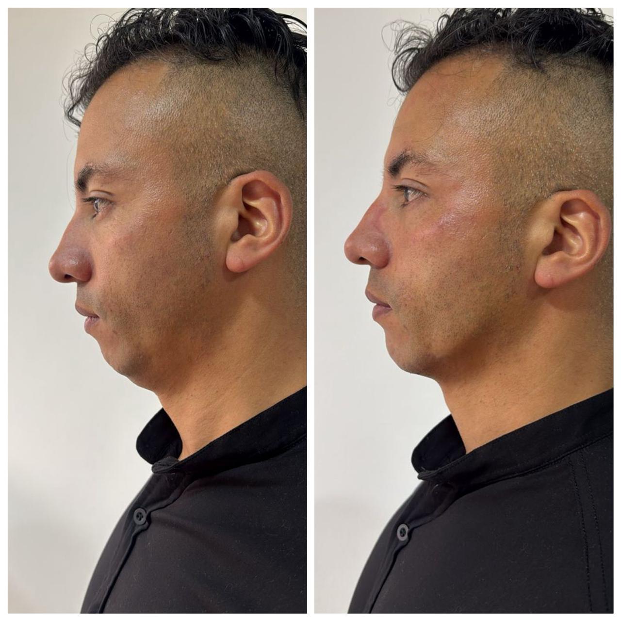 Antes y después real · Perfil y papada · Radiant Skin Bogotá