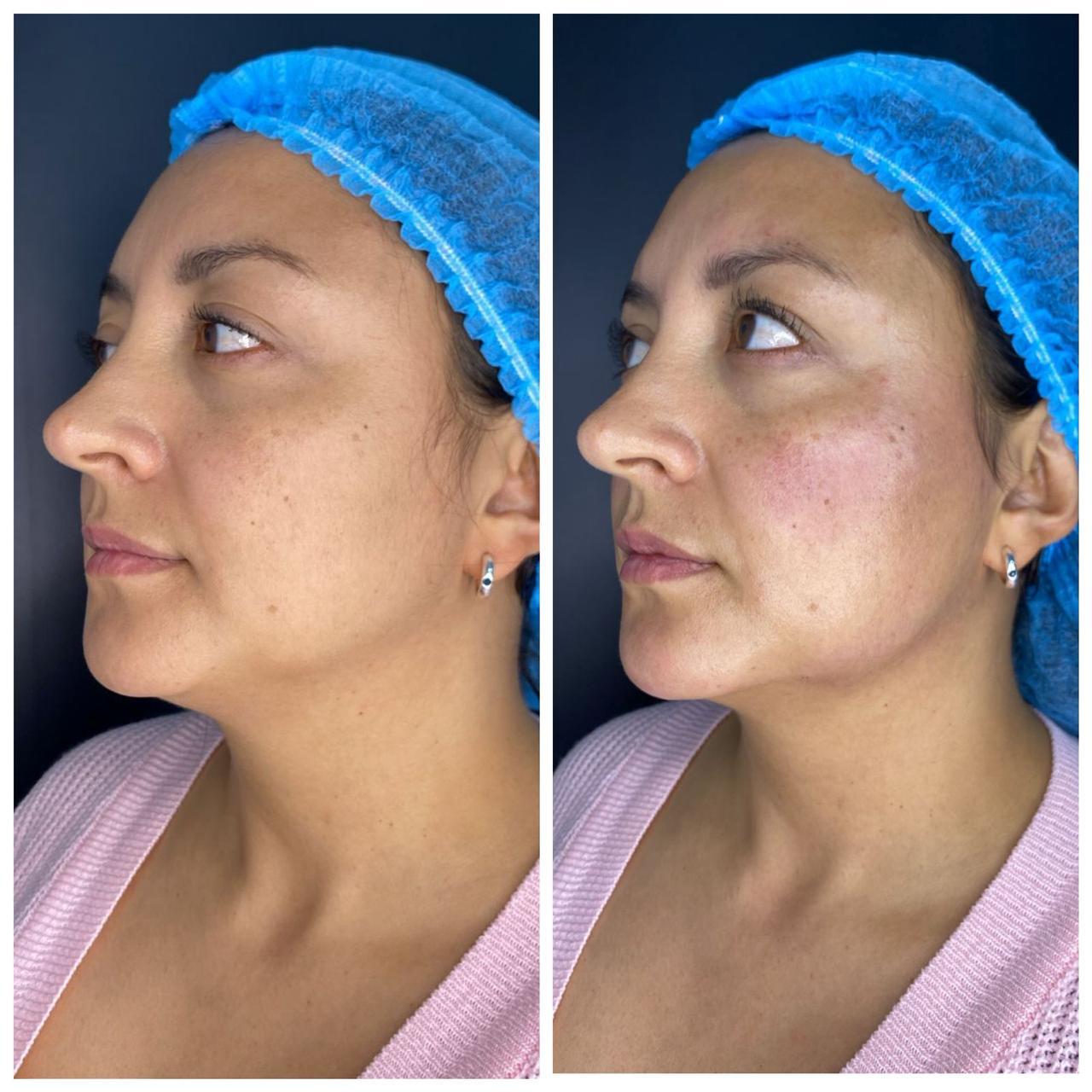 Antes y después real · Óvalo facial definido · Radiant Skin Bogotá