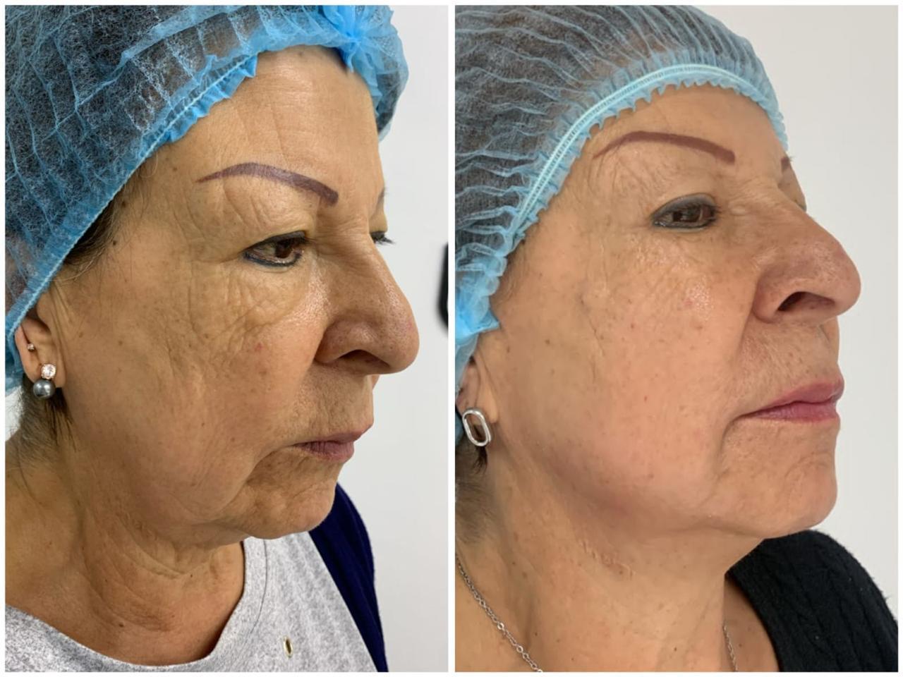 Antes y después real · Rejuvenecimiento integral · Radiant Skin Bogotá